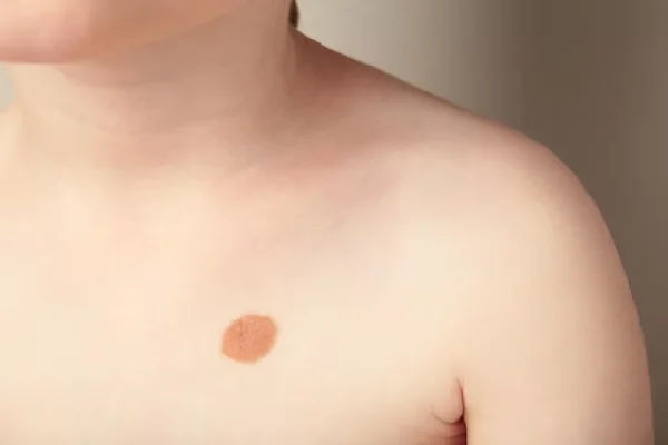 Warts Removal