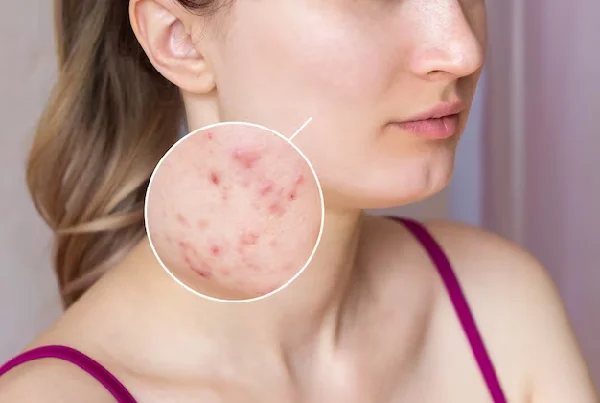 Scar Removal