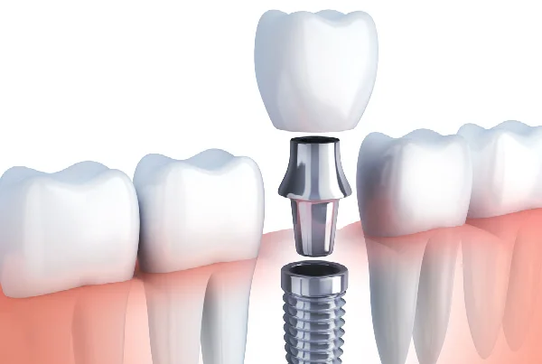 Dental Implants