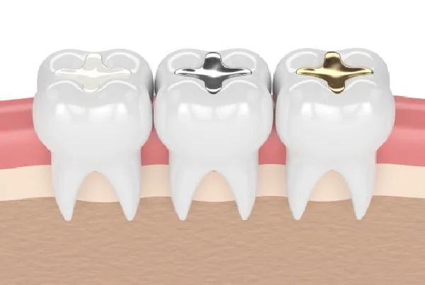 Dental Restorations and Fillings